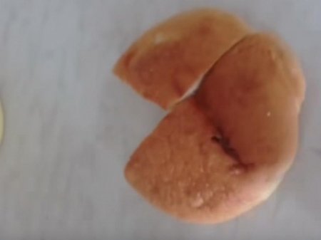 Vərəm dispanserində baş verən biabırçılığa Nazirlikdən AÇIQLAMA - VİDEO