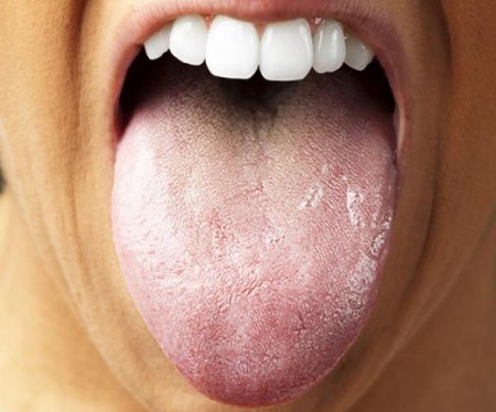 Dildə əmələ gələn ərp hansı xəstəliyin əlamətidir?